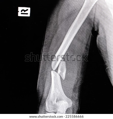 x-ray image of broken arm bone (Anatomy of fracture humerus )