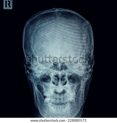 skull x-rays image