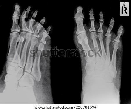 film x-ray show broken bones