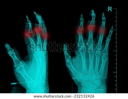 film x-ray show fracture