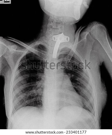pneumonia test scanning, modern x-rays radiography details