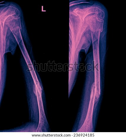 x-ray image of broken arm bone