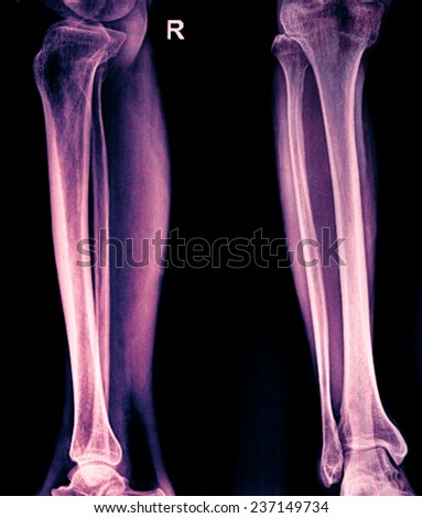 human leg bones
