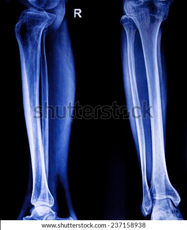human leg bones
