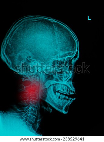 X ray Image of Spinal Column Neck pain and Skull Head Stress