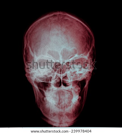 X-ray normal asian skull
