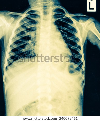 Chest x-ray film of children ( chest posterior-anterior )