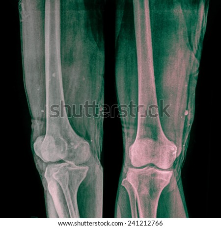 X-ray of  human knees