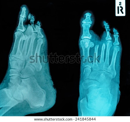 film x-ray show broken bones