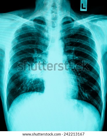 X-ray of human cancer lungs