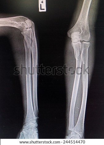 X-ray forearm ( front , side ) : Comminuted fracture shaft of ulnar bone ( forearm bone )