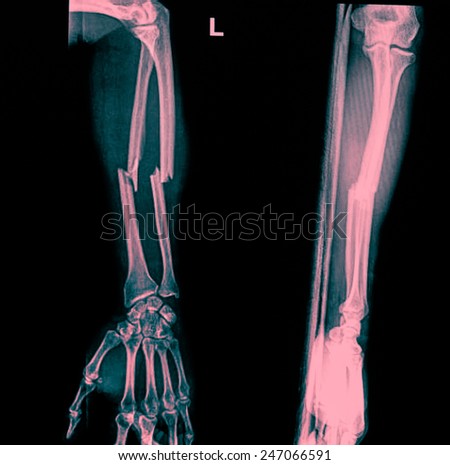 X-ray hand fracture