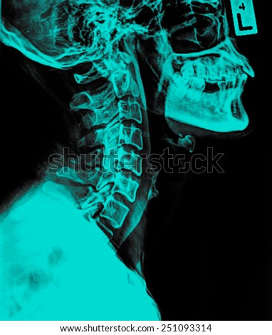 Image of Spinal Column Neck pain and Skull Head Stress