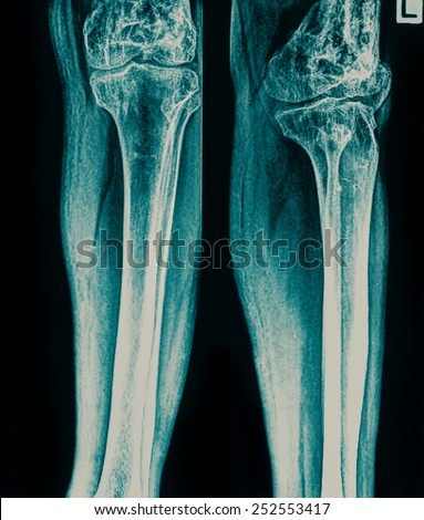 X-ray of painful knee / Many others X-ray images in my portfolio.