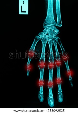 film x-ray both human\'s hands and arthritis at multiple joint (Gout,Rheumatoid)