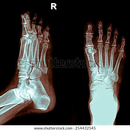 x-ray image of a foot, front and side view