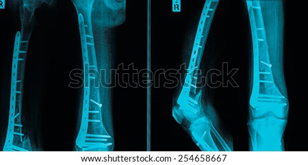 X-ray of leg with metal plates , 2 view