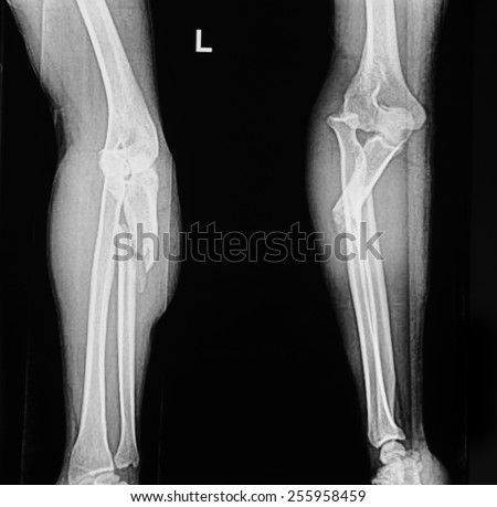 Bones broken arm