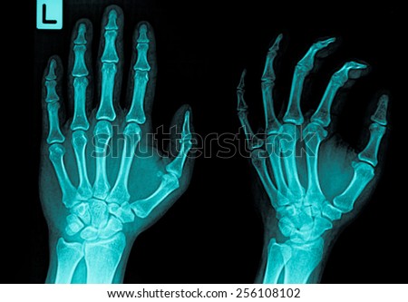 Human Left hand x-ray - Medical Image
