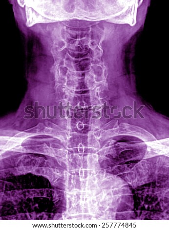 X-ray image of neck cervical spine isolated on black background