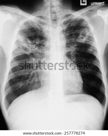 film chest x-ray image of adult human