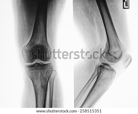 X-ray of human knees