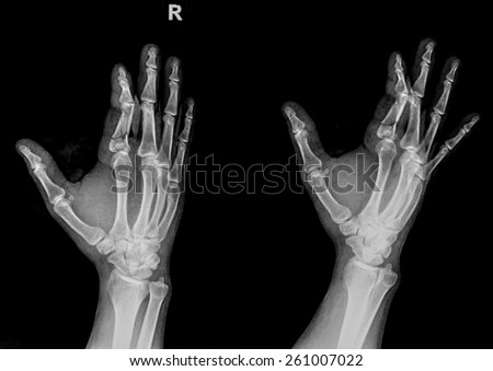 x ray of a hand with broken finger
