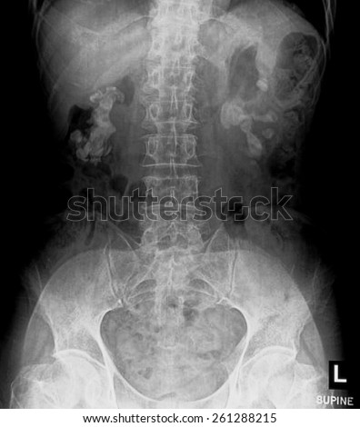 Bilateral renal calculi(stag horn) (Kidney stones)