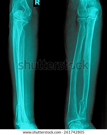 Bones broken arm