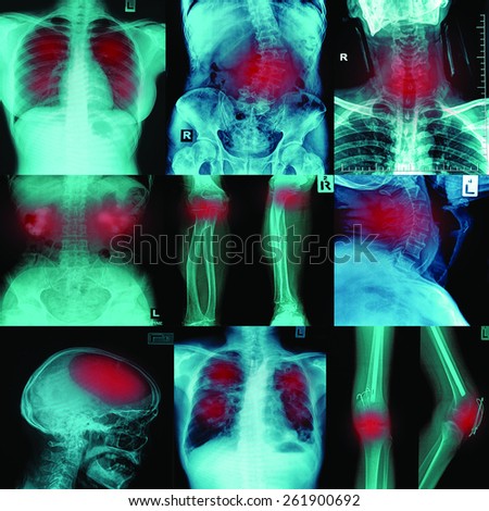 Collection x-ray multiple disease (arthritis,stroke,brain tumor,gout,rheumatoid,kidney stone,pulmonary tuberculosis,osteoarthritis knee, etc)