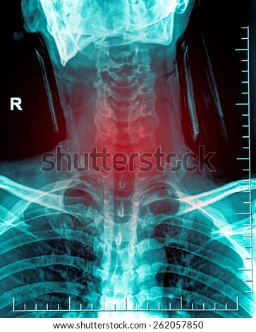 X-ray image of neck cervical spine