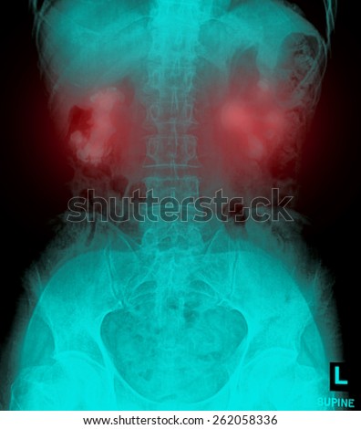Bilateral renal calculi(staghorn) (Kidney stones)