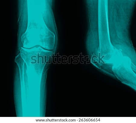 collection of x-ray normal knee