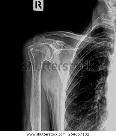 x-rays image of the painful or injury shoulder joint