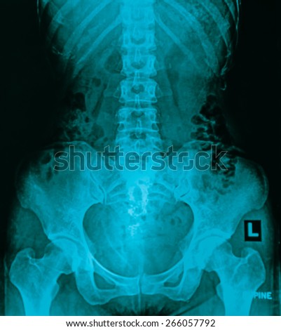 X-ray lumbo-sacral spine and pelvis of asian adult people