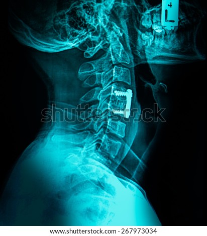 cervical neck x-ray