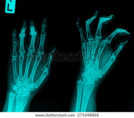 x ray of a hand with broken finger