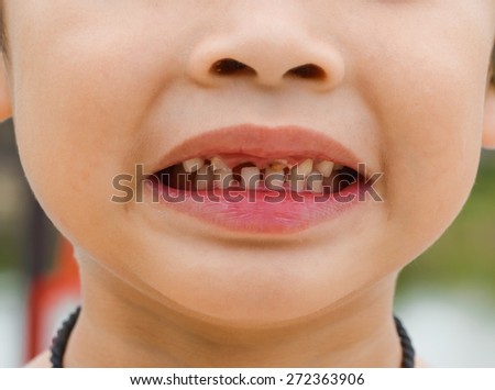 kid patient open mouth showing cavities teeth decay