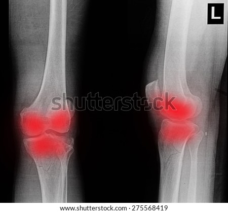 X-ray of painful knee