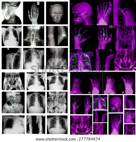 Collection x-ray multiple disease (arthritis,stroke,brain tumor,gout,rheumatoid,kidney stone,pulmonary tuberculosis, etc)