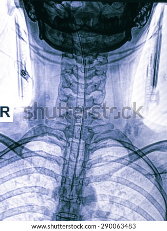Xray of neck and cervical spine, front view.