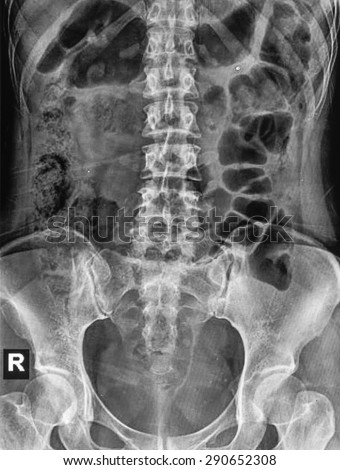 Small bowel obstruction. Film X-ray abdomen supine