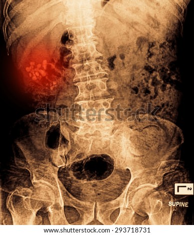 x ray for kidney stones