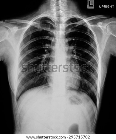 X-ray of chest of healthy patient