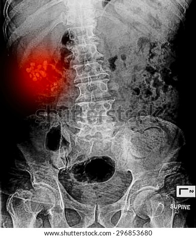 X-ray image of Kidney and Urinary bladder system