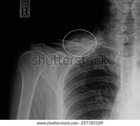 X-ray film of shoulder fracture.