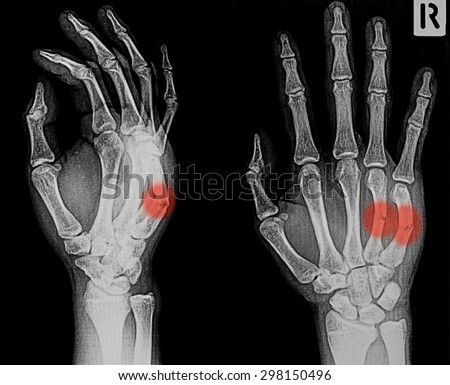 X-ray image of broken hand, AP and oblique view, show metacarpal fractures.