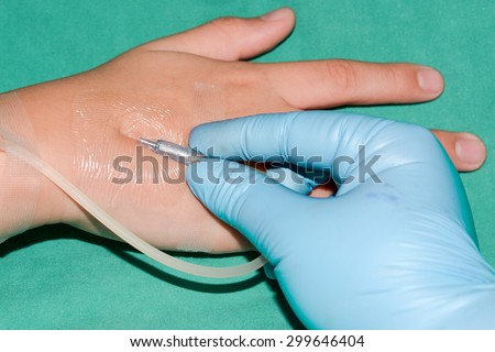 Nurse removing iv needle with selective focus
