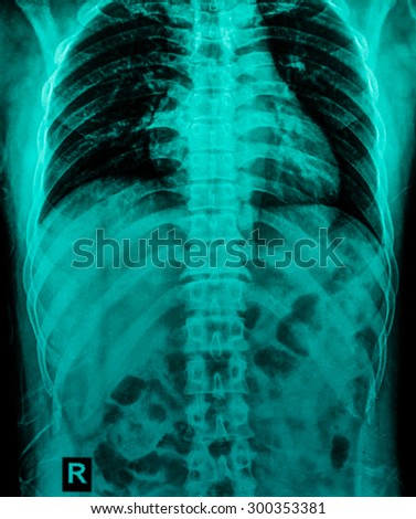 X-ray image of abdomen supine position.