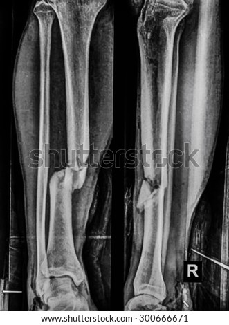 X-ray image of lower leg, AP  view. Shows tibia  fractures